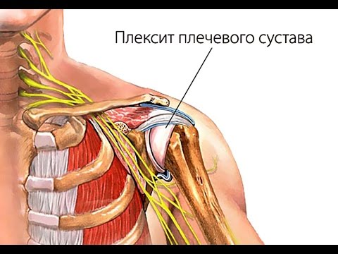 Плексит: симптомы и лечение - статьи от компании Еламед