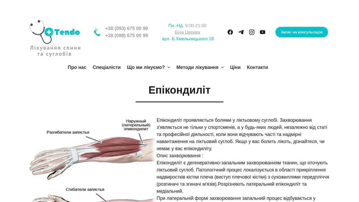 Епікондиліт