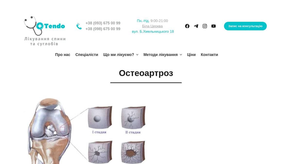 Остеоартроз
