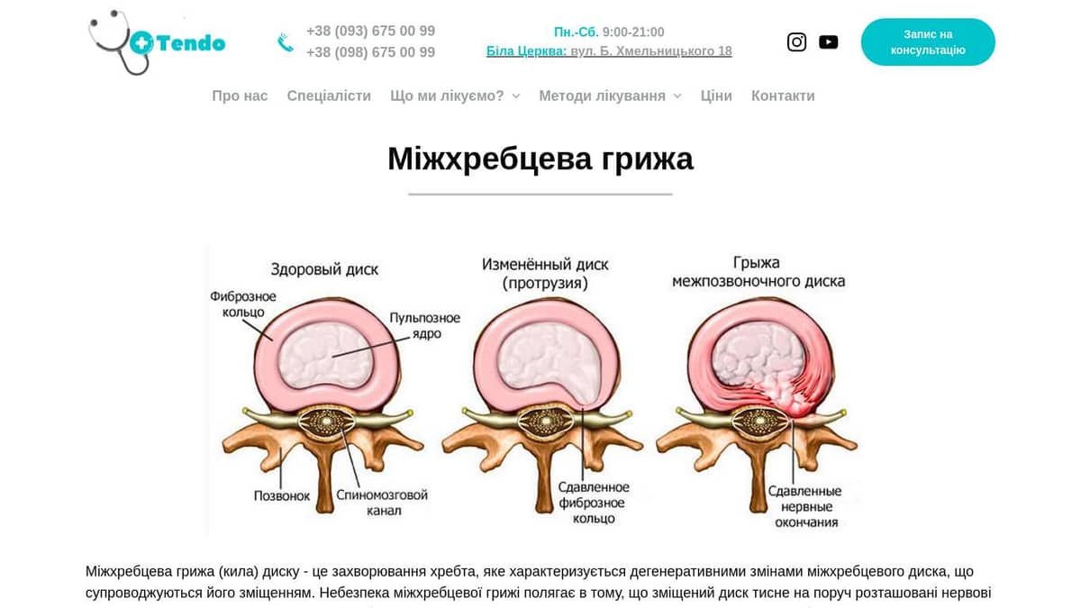 Грыжа диска позвоночника симптомы. Позвоночник с грыжей в пояснице. Грыжи позвоночника дают ли группу. Междисковая грыжа позвоночника. Межпозвоночная грыжа.