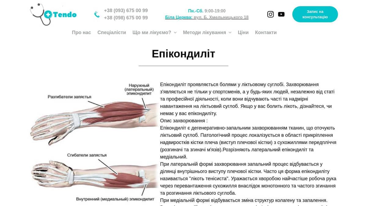 Епікондиліт